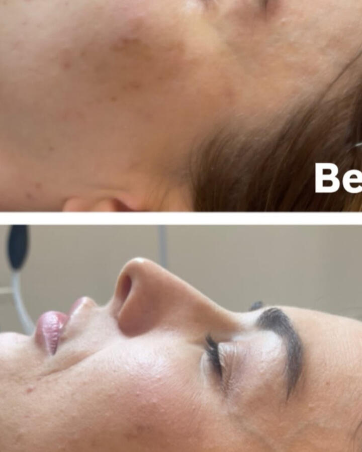 Rezultat MARAE - ten inainte si dupa Rezultat real - tratament facial personalizat
